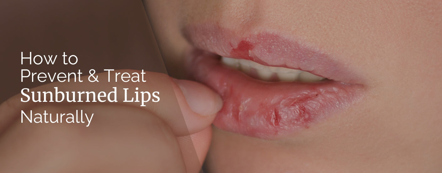 How to Prevent & Treat Sunburned Lips